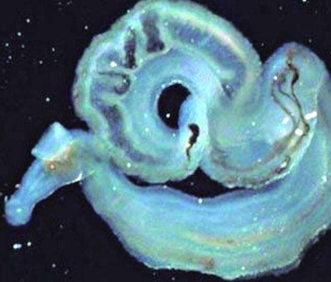 O parasita Schistosoma mansoni é o agente da esquistossomose
