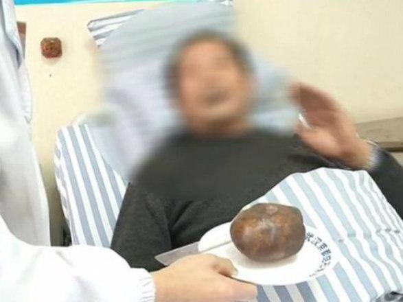 Zhou assustou-se ao ver a pedra que tinha em sua bexiga