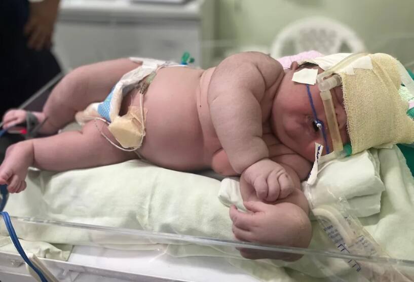 Bebè 7kg nasceu no Amazonas