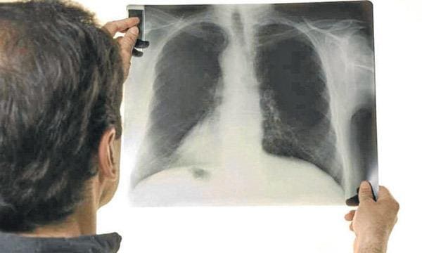 A tuberculose