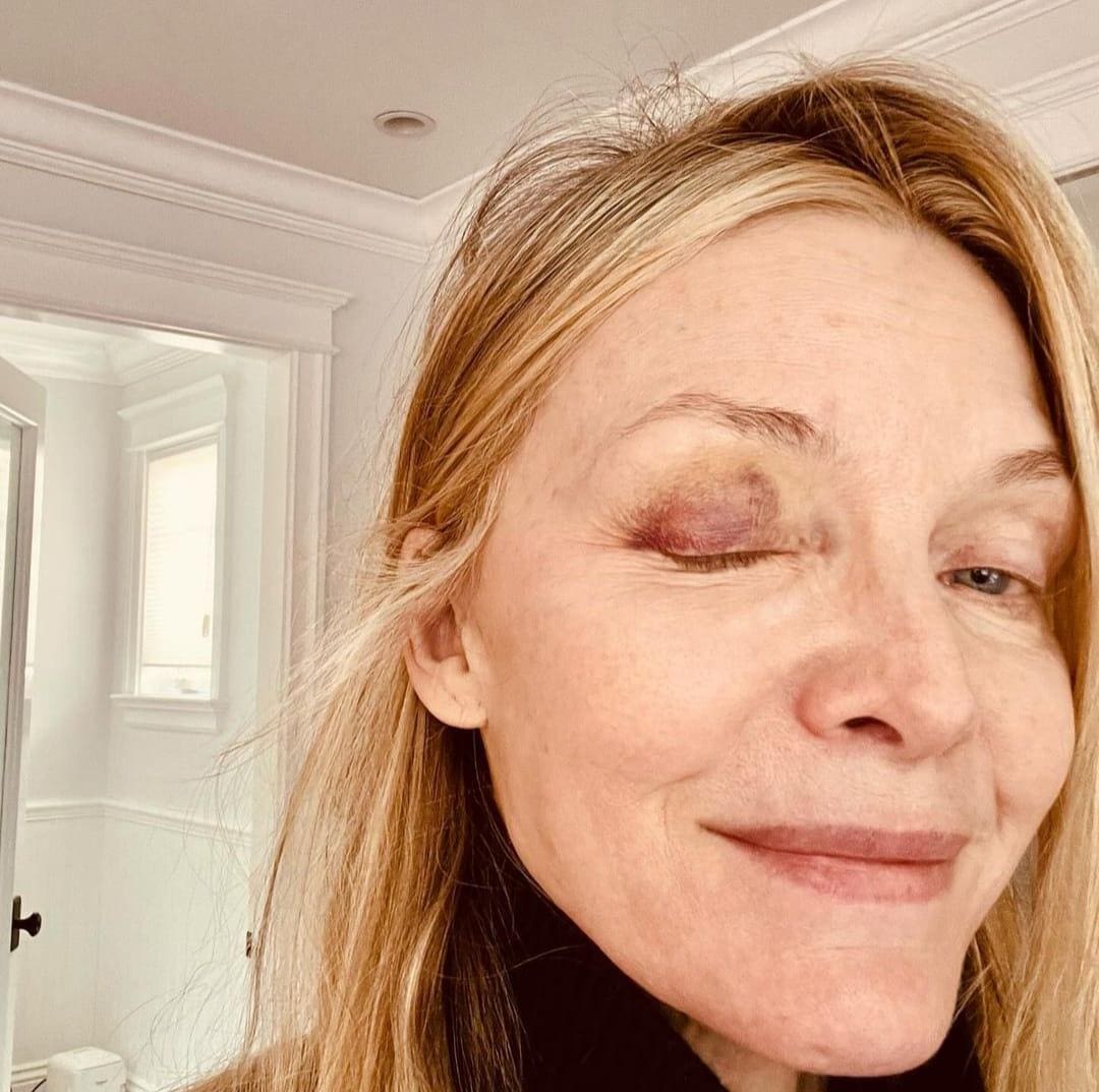 Michelle Pfeiffer usou suas redes sociais nesta sexta (1) para postar fotos em que aparece com o olho direito roxo