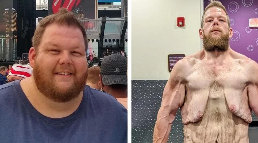 Americano perde mais de 160 kg e faz vaquinha para cirurgia de retirada de pele