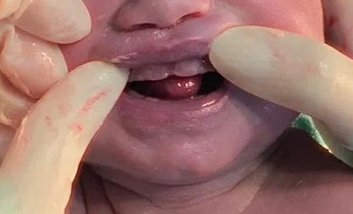 Bebê nasce com dentes e surpreende família e equipe médica em Campo Grande
