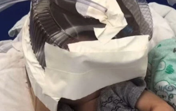 Máscara improvisada ajudou bebê a respirar enquanto ele aguardava por transferência 