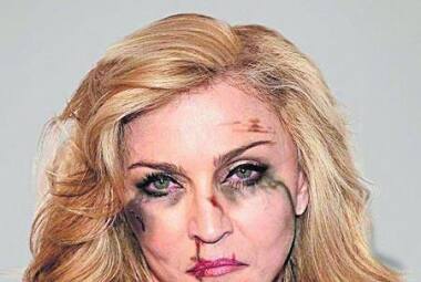 A cantora Madonna também ganhou hematomas
