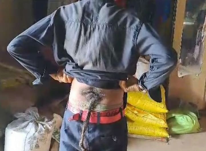 Rabo de cabelo em adolescente indiano cresce no corpo dele desde que ele era uma criança