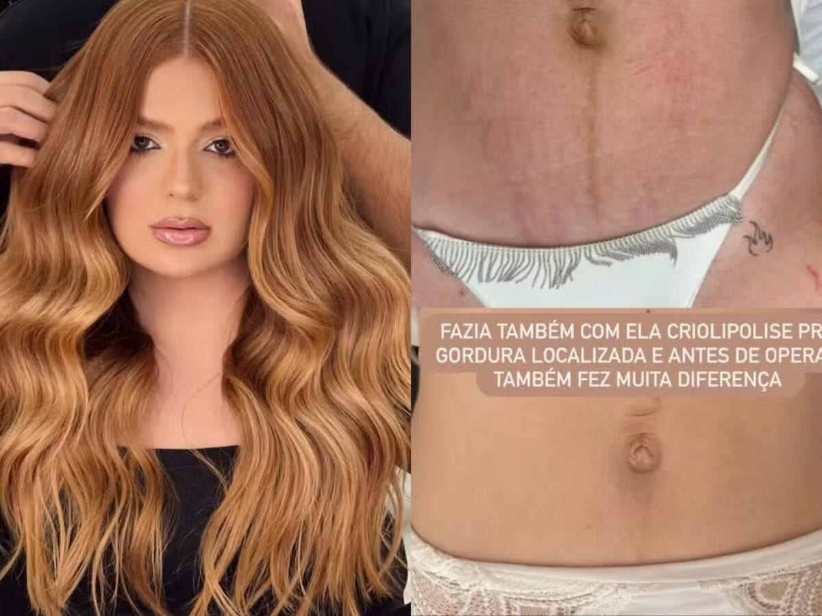 'Funcionou muito': Viih Tube surpreende com antes e depois de estrias com tratamento após gravidez