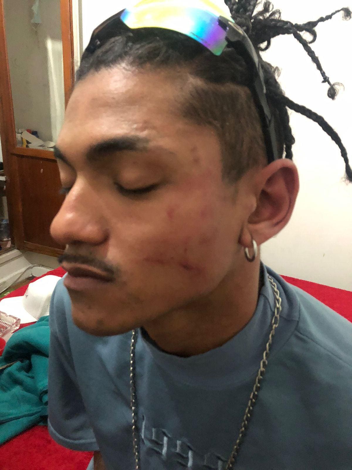 Foto do cozinheiro com hematomas após ser agredido em show
