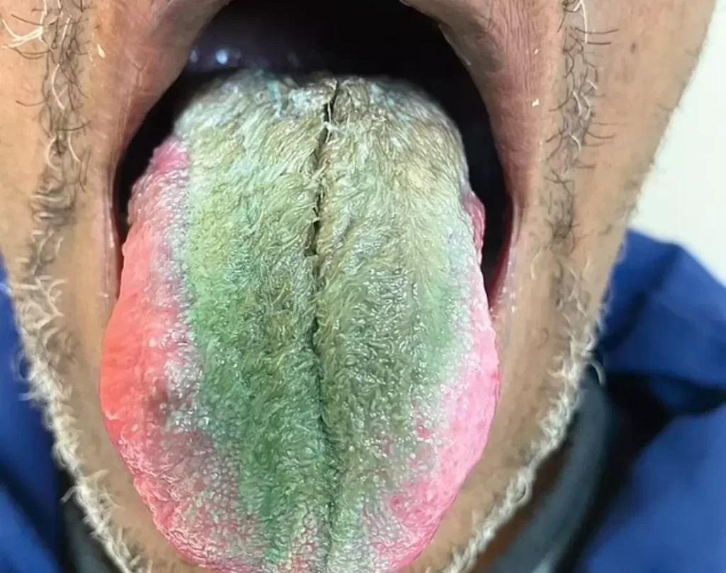 Língua verde e peluda