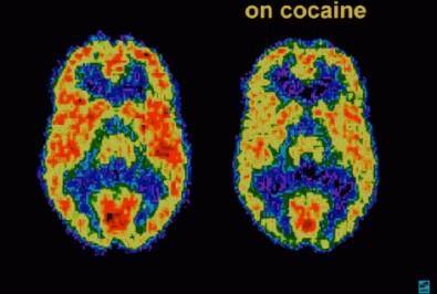 Grupo da Faculdade de Medicina da USP combinou análise de déficits cognitivos e do padrão de uso da droga para identificar os pacientes com risco aumentado de recair após o tratamento (Tomografia por emissão de pósitrons (PET) revela como a cocaína altera o metabolismo de glicose no cérebro