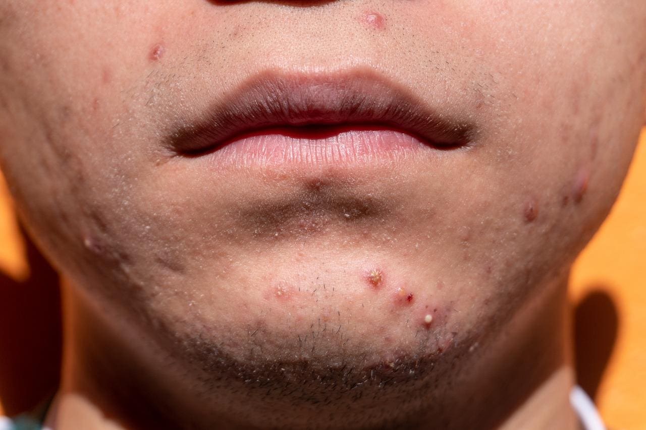 Imagem ilustrativa de um homem com acne no rosto
