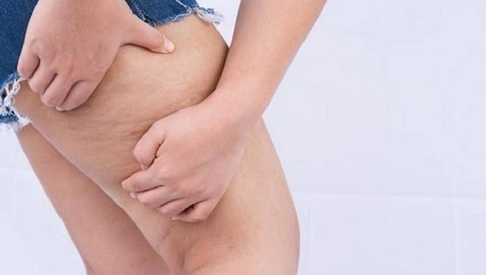 O lipedema é caracterizado pelo acúmulo de tecido adiposo nas pernas, quadris e braços e pode estar relacionado com as flutuações hormonais da mulher