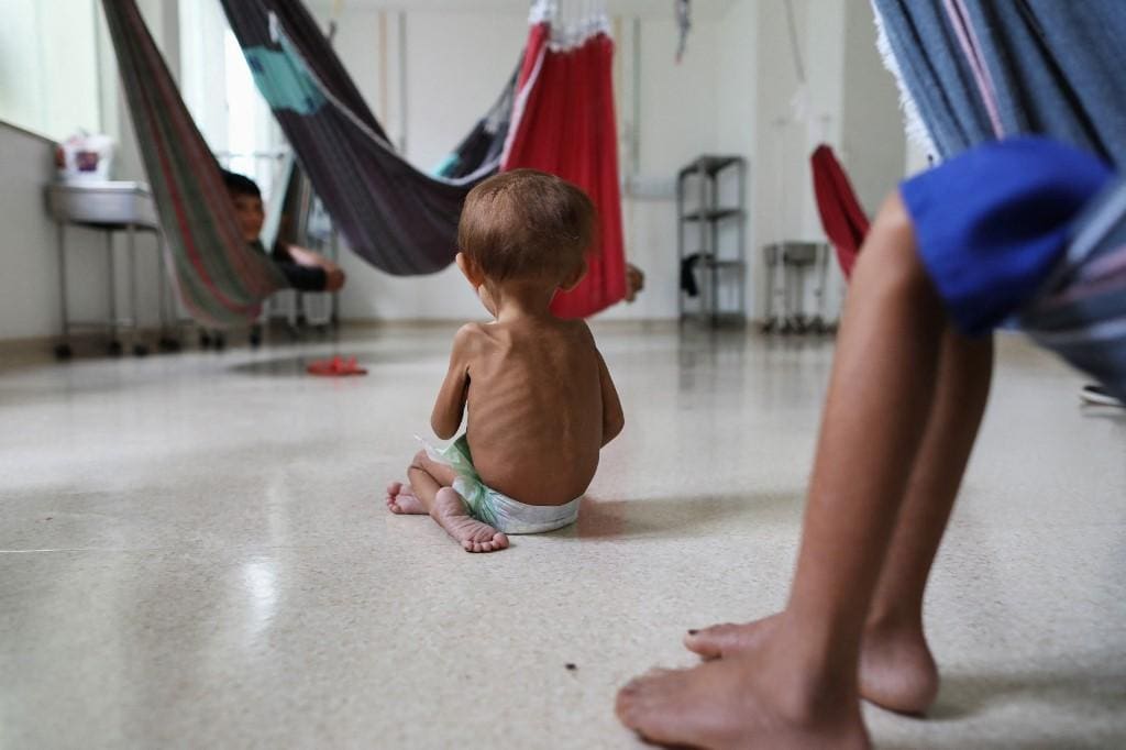 Criança Yanomami desnutrida é tratada em hospital infantil de Boa Vista