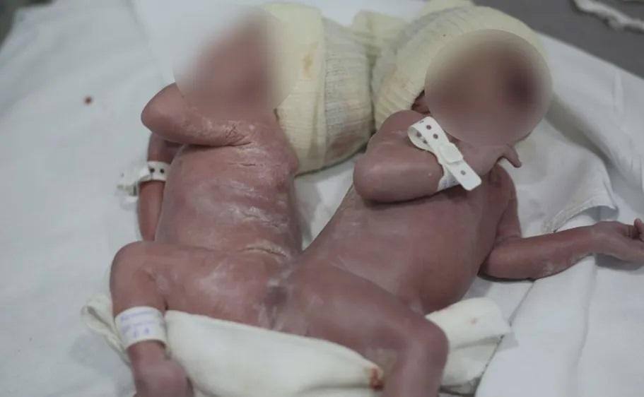 Segundo a médica Marina Nunes Machado, responsável pelo parto, a união através do sacro é ainda mais rara do que a maioria dos casos de gêmeos siameses.