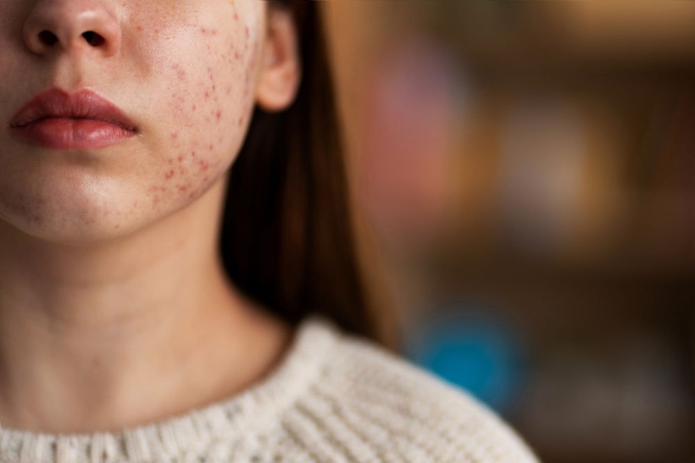 O vírus da herpes zoster ou 'cobreiro' A herpes zoster se manifesta por meio de lesões avermelhadas, doloridas e com bolhas