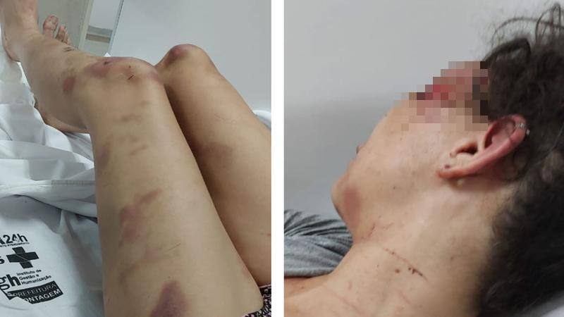 Na foto, a mulher está deitada com marcas roxas a mostra por todo corpo
