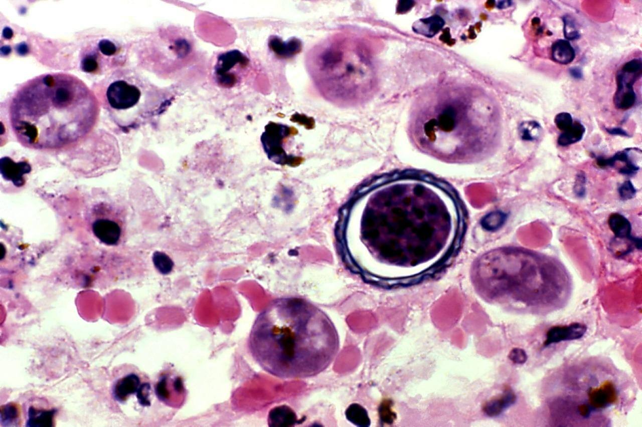 Infecção pela ameba Naegleria fowleri pode provocar morte