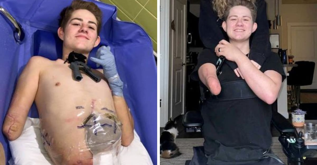 Jovem passou por uma hemicorporectomia para ter a vida salva após sofrer acidente com empilhadeira