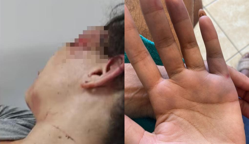 Hematomas de violência no rosto de Jéssica e na mão da Luana*