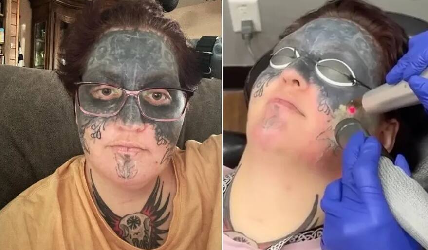 Mulher começa a remover tatuagem que foi feita nela à força por ex-namorado