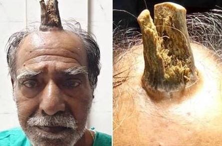“Chifre” começou a crescer após o indiano sofrer uma queda, e que no início ele não se incomodou por ser pequeno e não doer