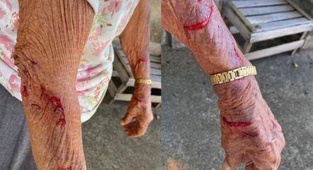 Mãe teve escoriações no braço após sofrer violência doméstica pelo próprio filho