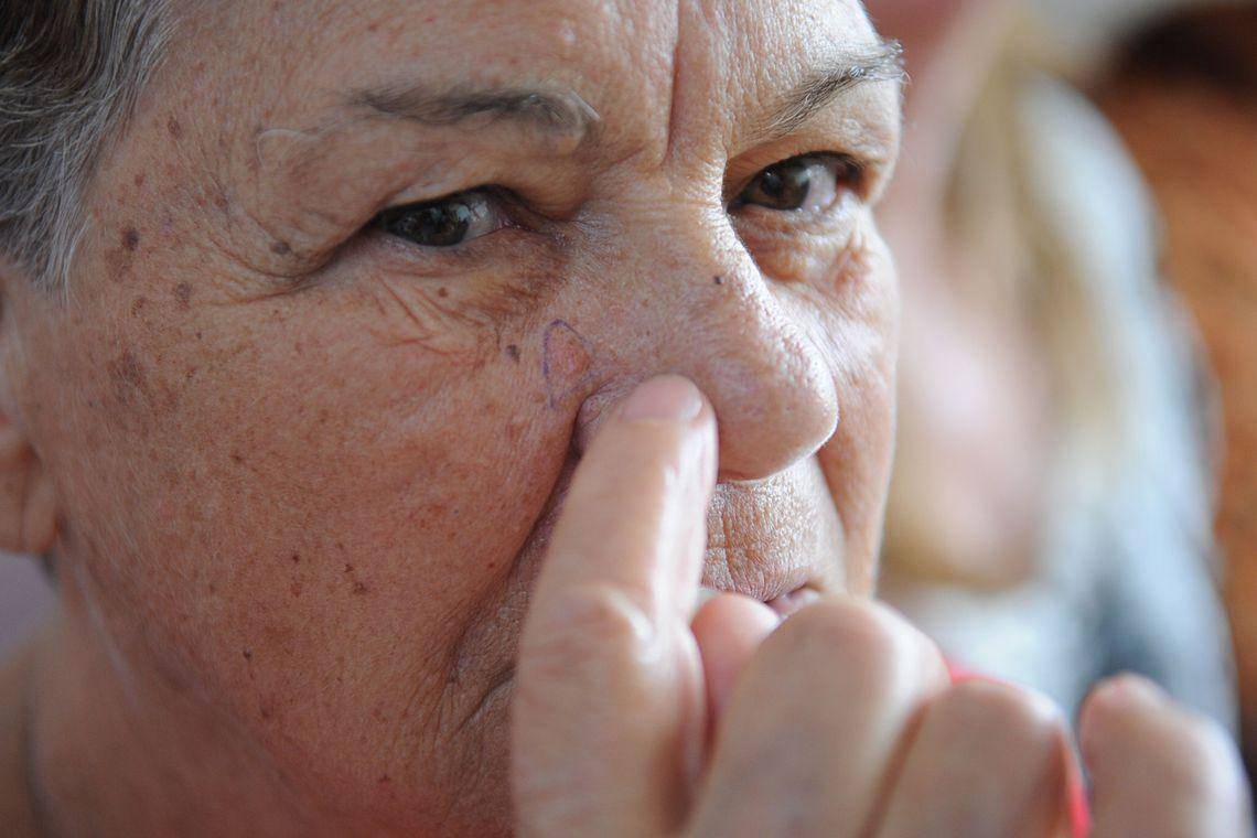 O câncer de pele não-melanoma compreende os tumores mais comuns, que ocorrem principalmente em pessoas de pele clara, após exposição solar por longo tempo