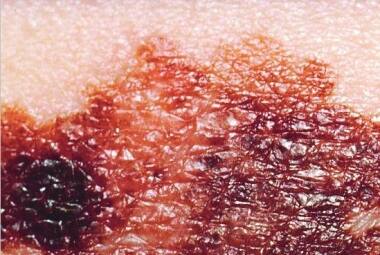 Pinta característica do melanoma, câncer de pele mais mortal