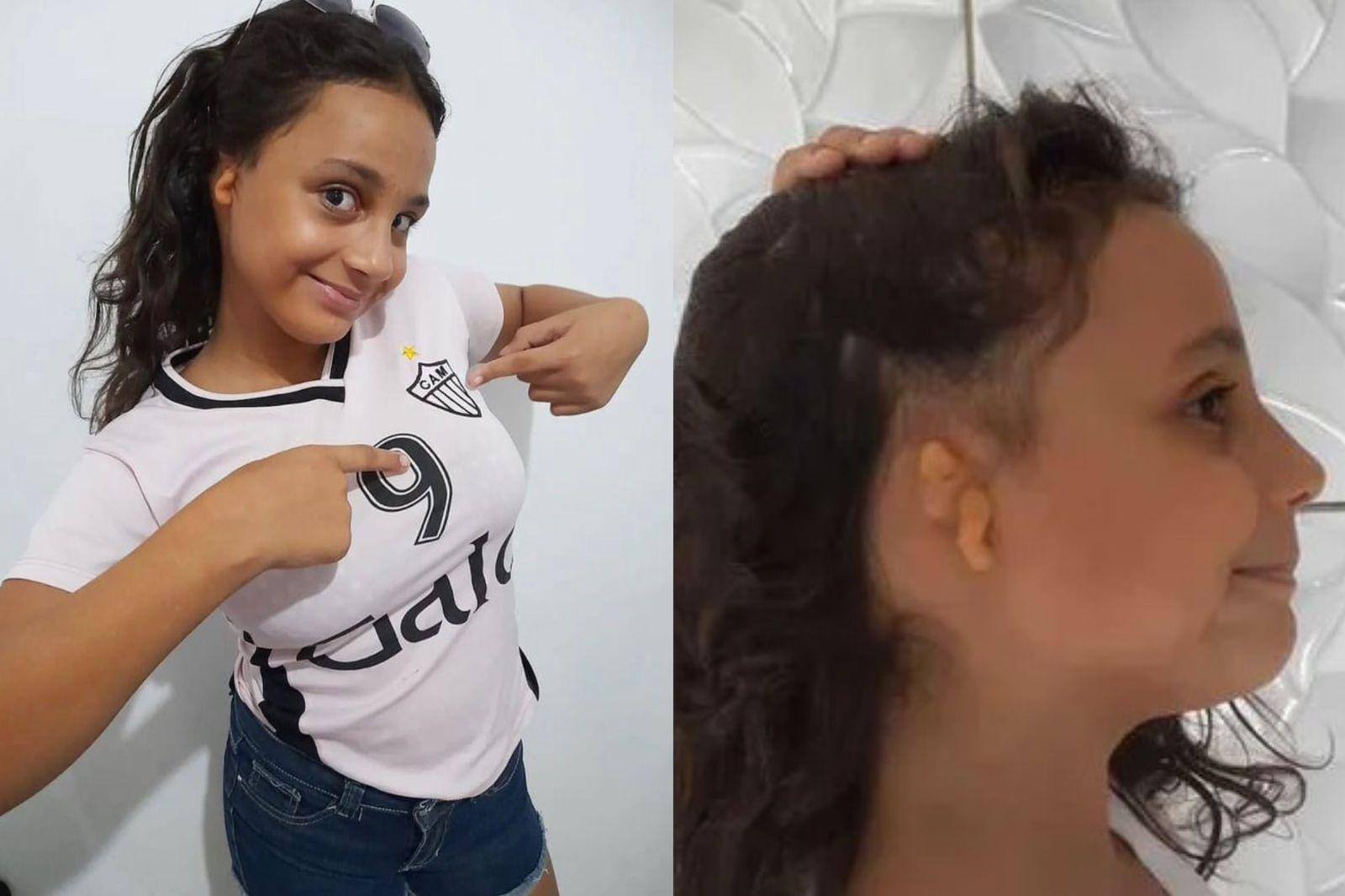 Pequena Ana Cecília, de 10 anos, diagnosticada com microtia na orelha direita