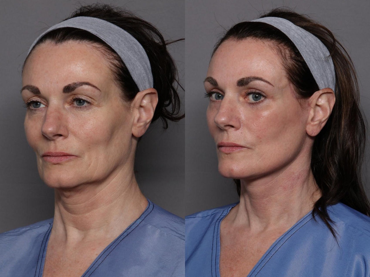 Fez um facelift ? Seu passaporte pode perder validade, alerta Polícia Federal