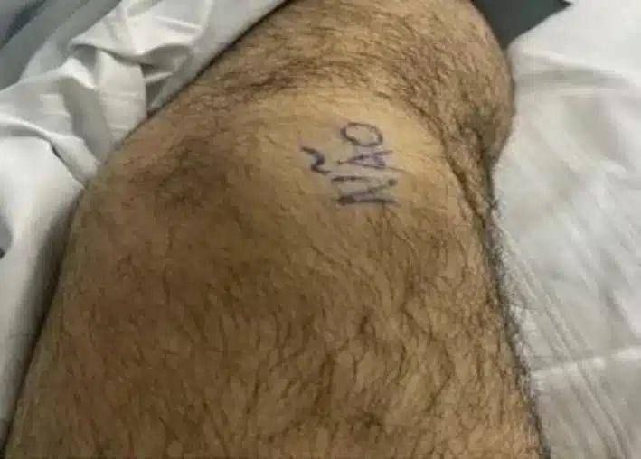 Paciente escreve ‘não’ na perna antes de cirurgia para marcar qual joelho deveria ser operado em Fortaleza.