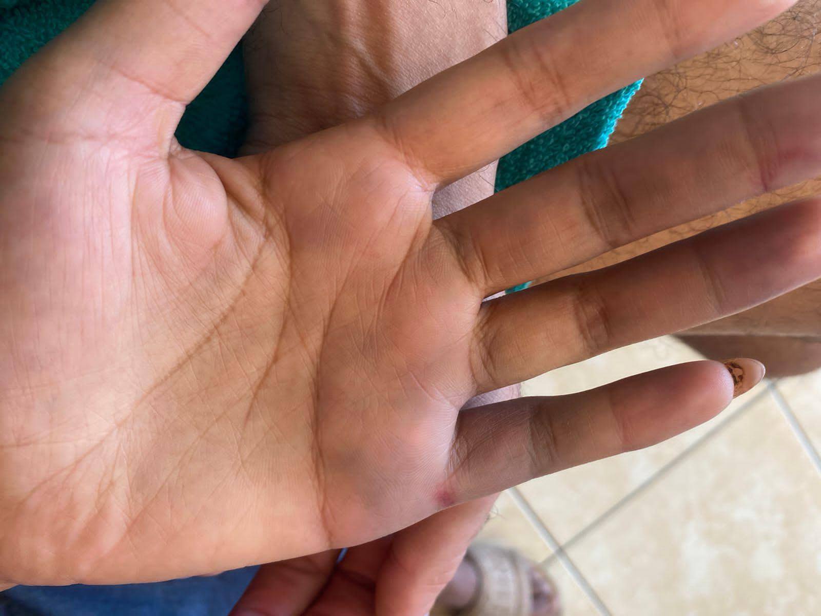Marcas das agressões em uma das mãos da vítima