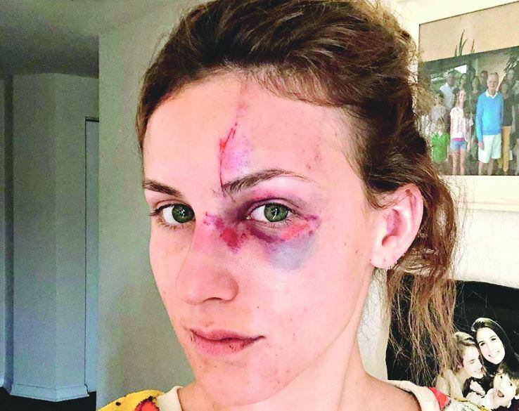 Melissa ficou com o rosto machucado após as agressões sofridas do namorado