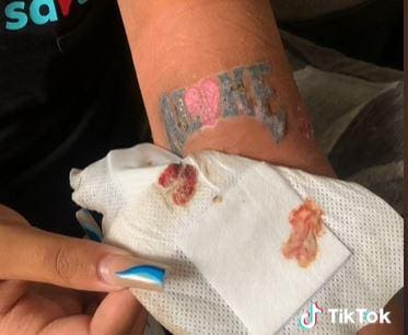 Braço de inglesa apodrece após tatuagem: 'profissional sem higiene'