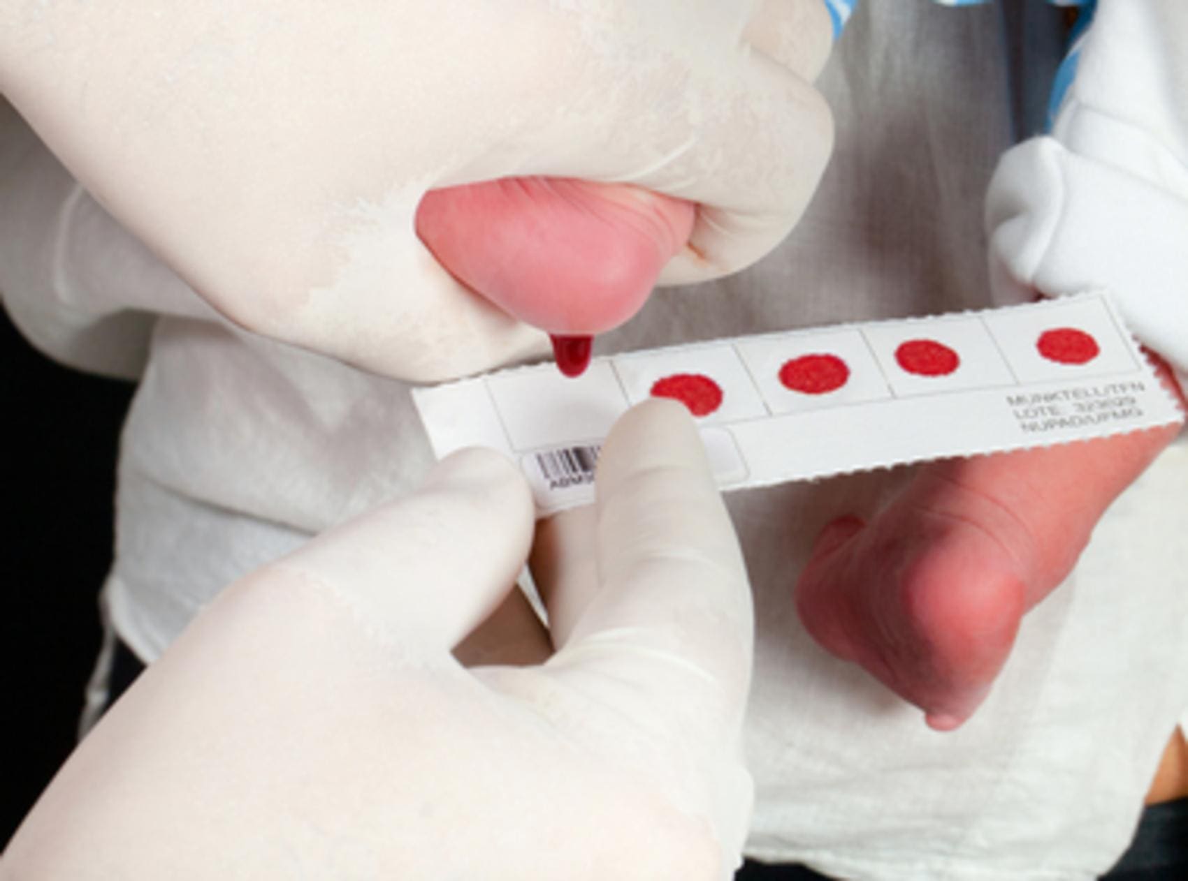 O teste do pezinho é um instrumento importante para o diagnóstico precoce das doenças raras