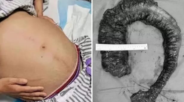 Mulher constipação China cocê 20kg 1 metro