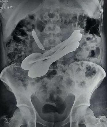 Faca e colheres foram vista no estômago do paciente durante o raio x