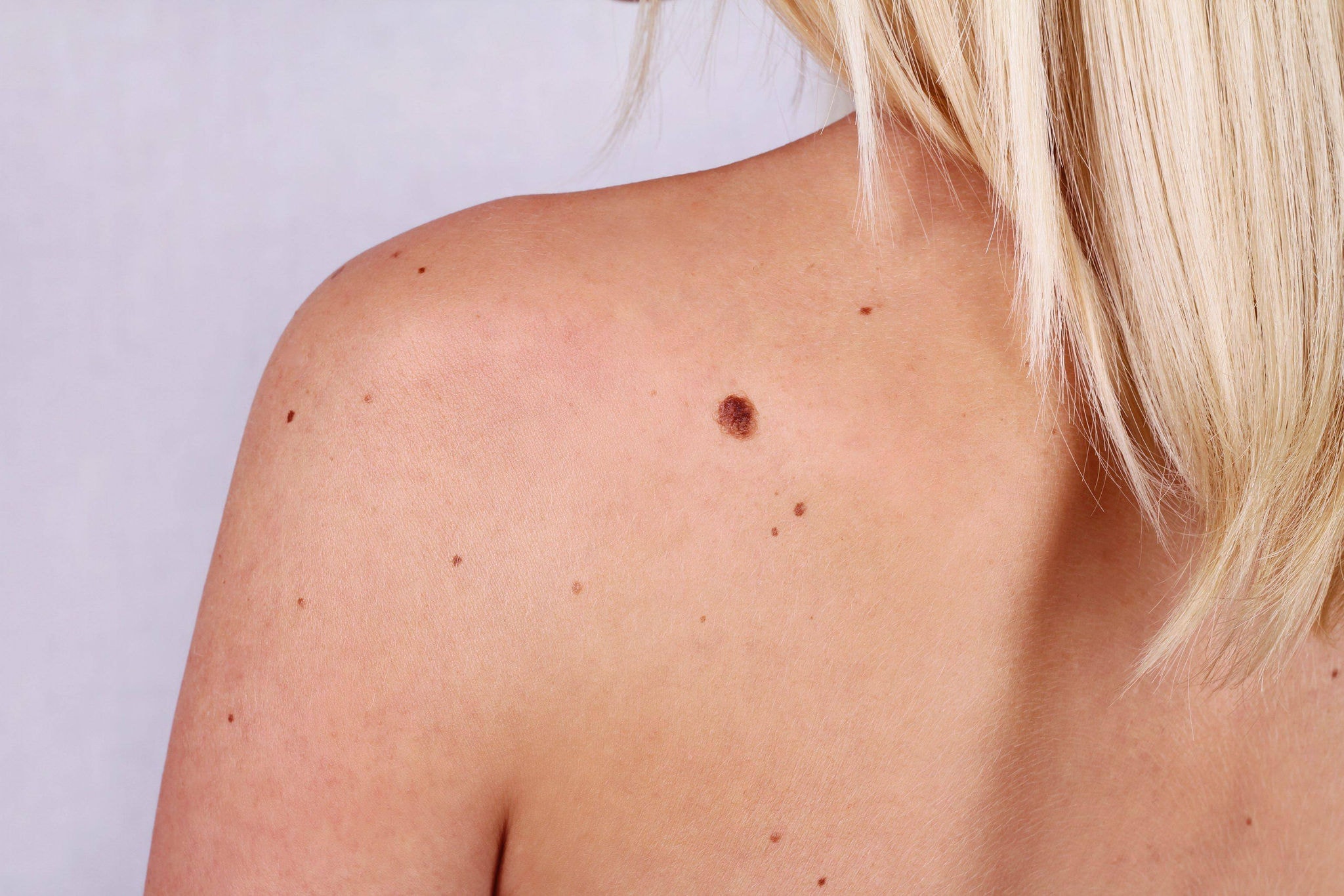Pintas na pele  Skin spot  manchas 