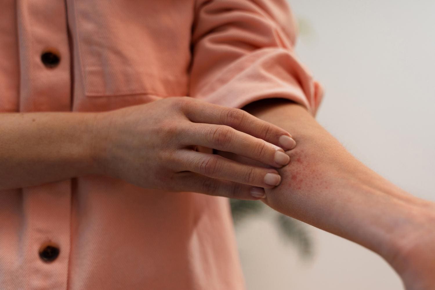 O Trichophyton indotineae é um tipo de dermatófito, ou seja, um fungo que causa infecções na pele