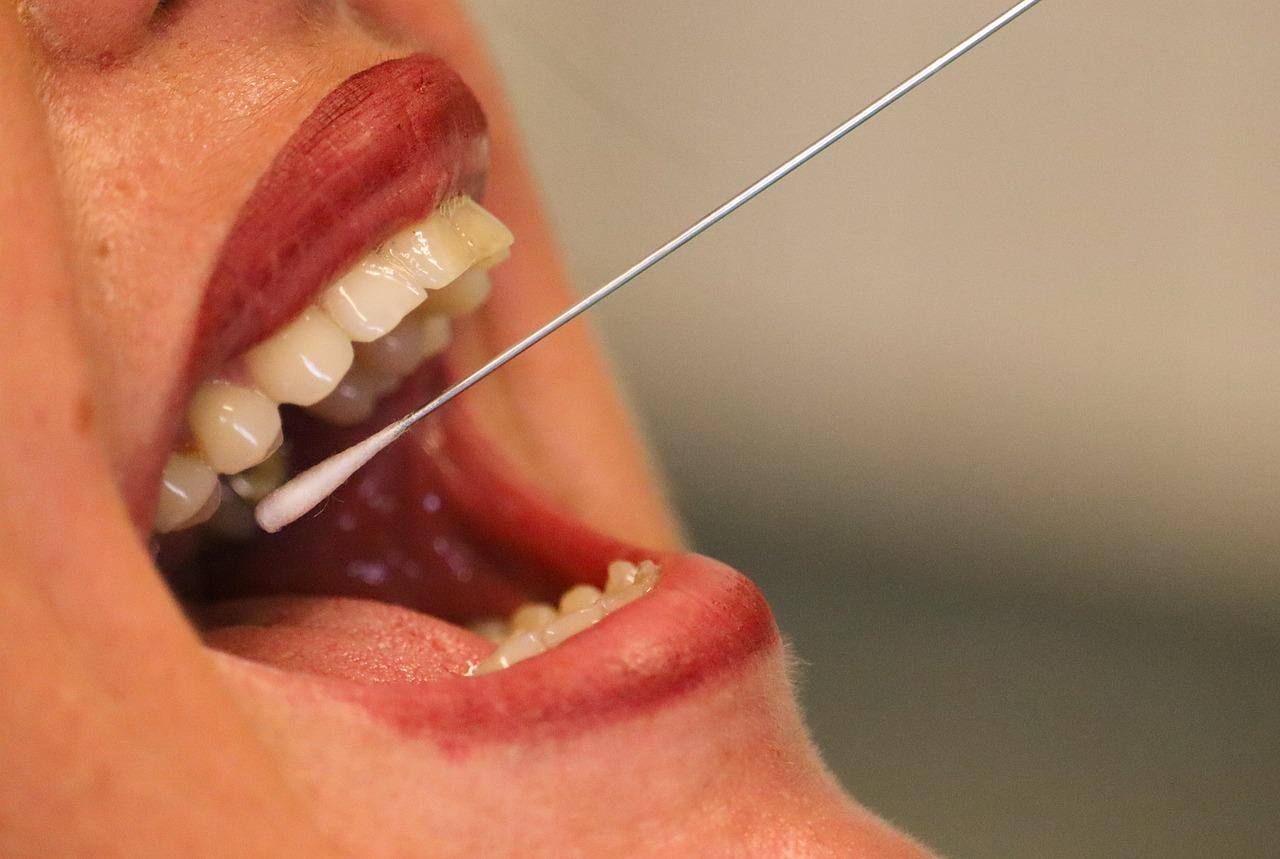 Imagem ilustrativa mostra um teste de Swab da garganta, que é utilizado no diagnóstico da bactéria
