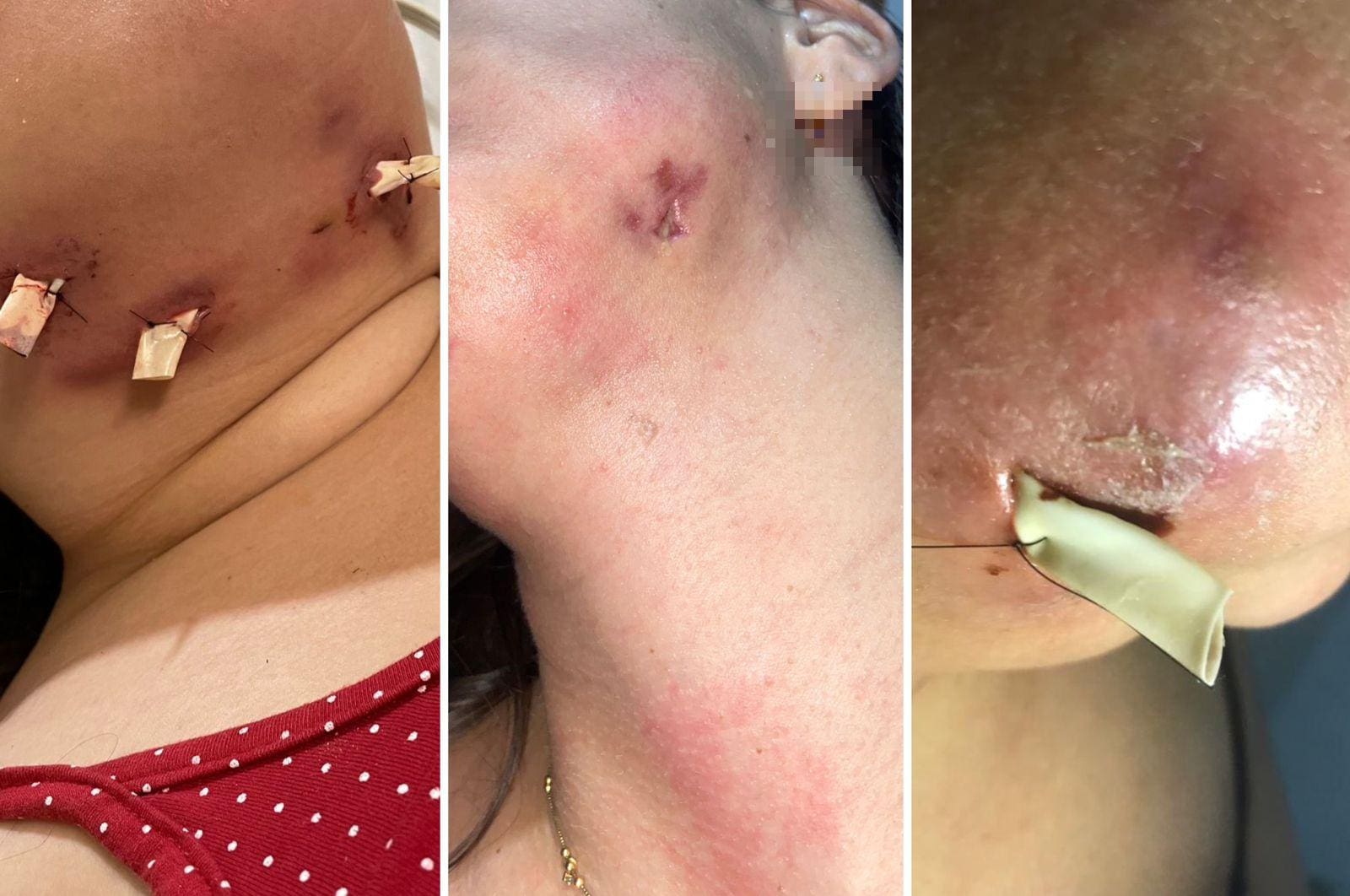 Mulheres têm complicações após cirurgia de lipo de papada em clínica de BH