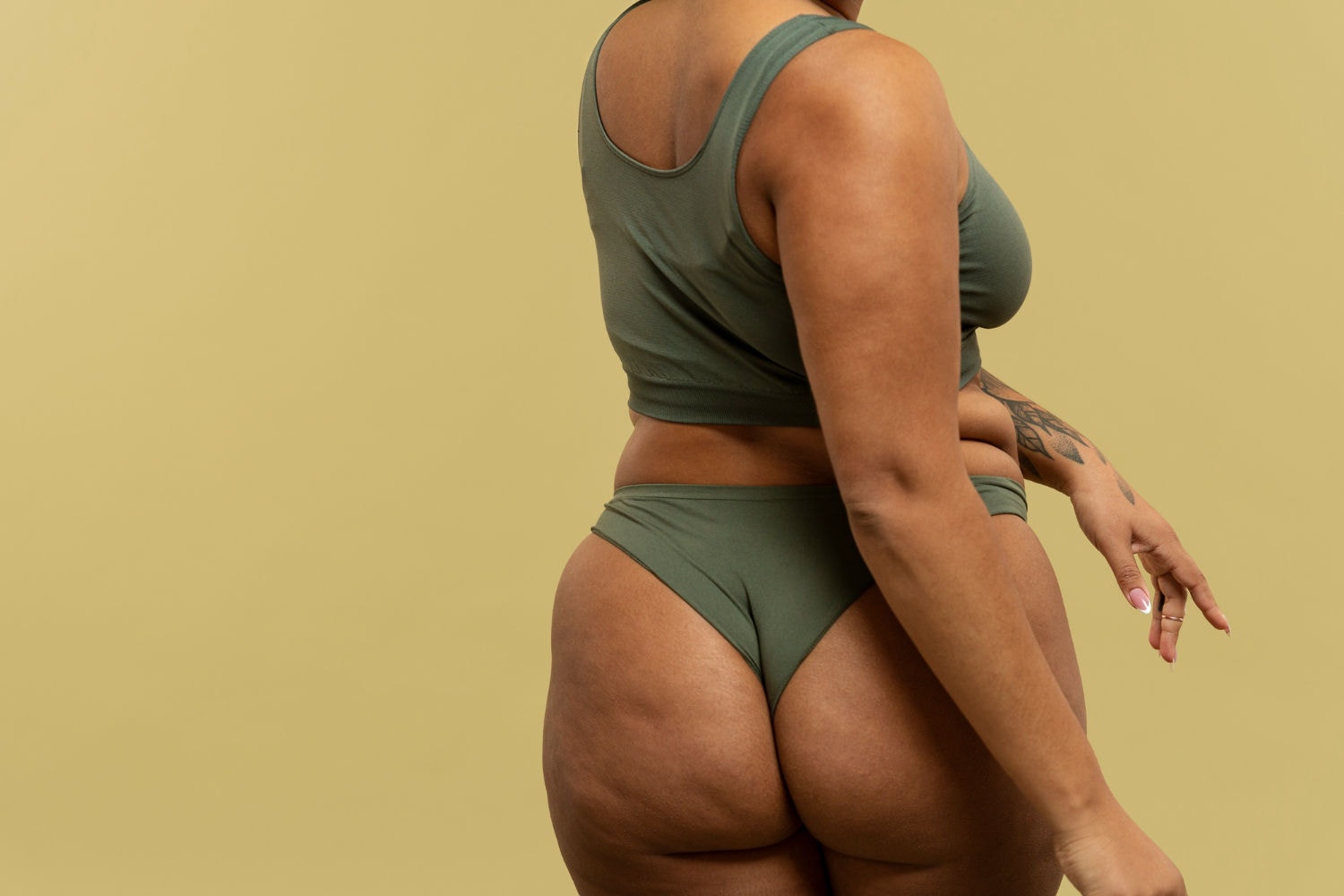 Normalmente, o lipedema começa nos quadris e nádegas, podendo se espalhar para coxas e pernas
