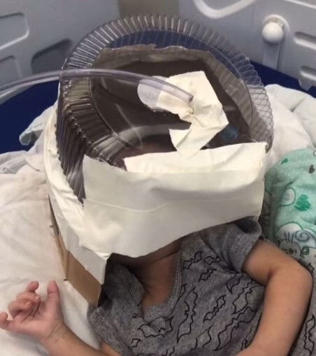 Bebê teve a vida salva pelo improviso dos médicos