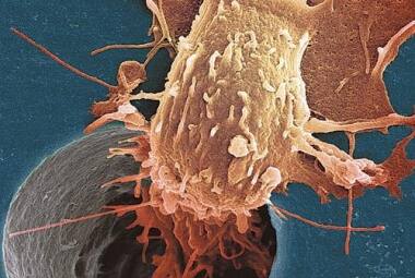 Raios Célula cancerosa pode ser incinerada com esferas de ouro aquecidas