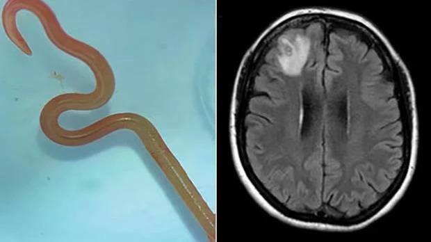 Um parasita de 8 centímetros, comum em cobras píton, foi encontrado pela primeira vez no cérebro de uma mulher de 64 anos