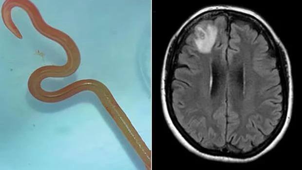 Verme comum em cobras píton é achado em cérebro humano pela 1ª vez