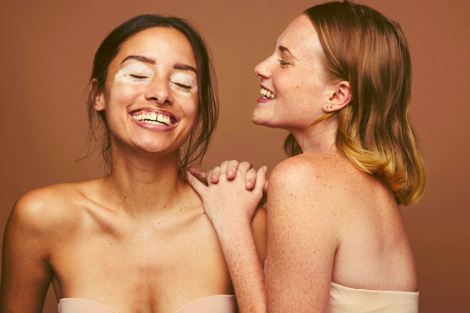 Vitiligo não tem cura, mas tratamentos podem ajudar 