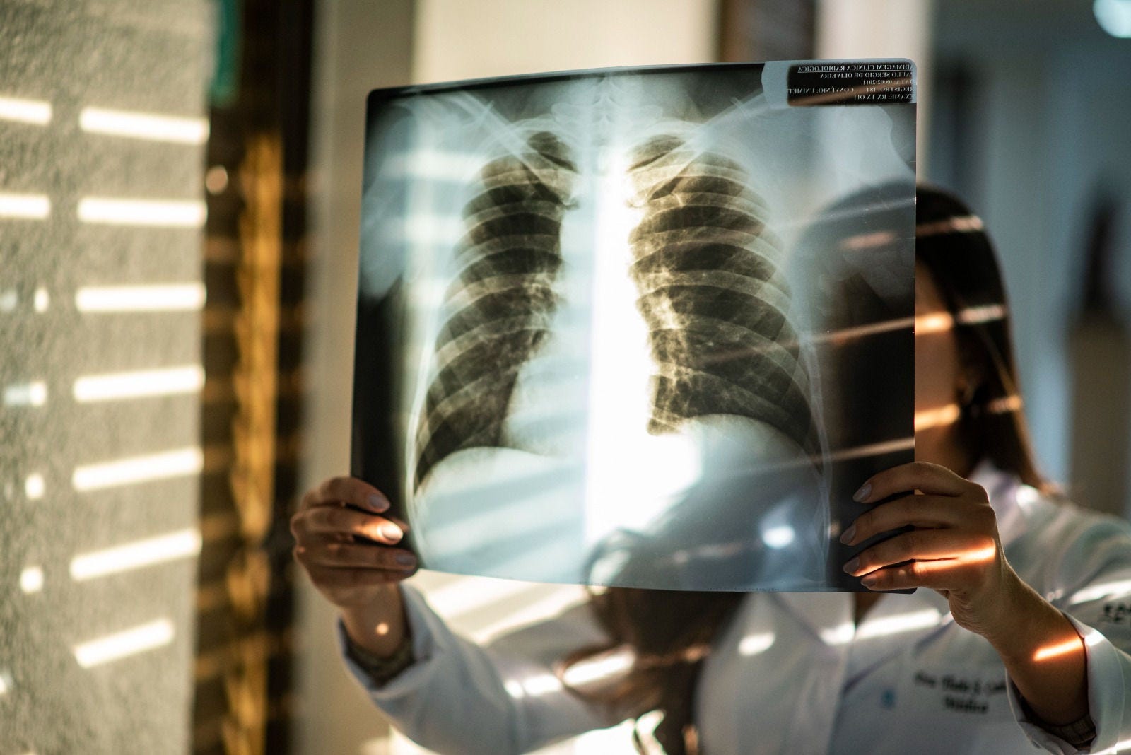 Médicos alertam: diagnóstico tardio de pneumonia aumenta o risco da doença
