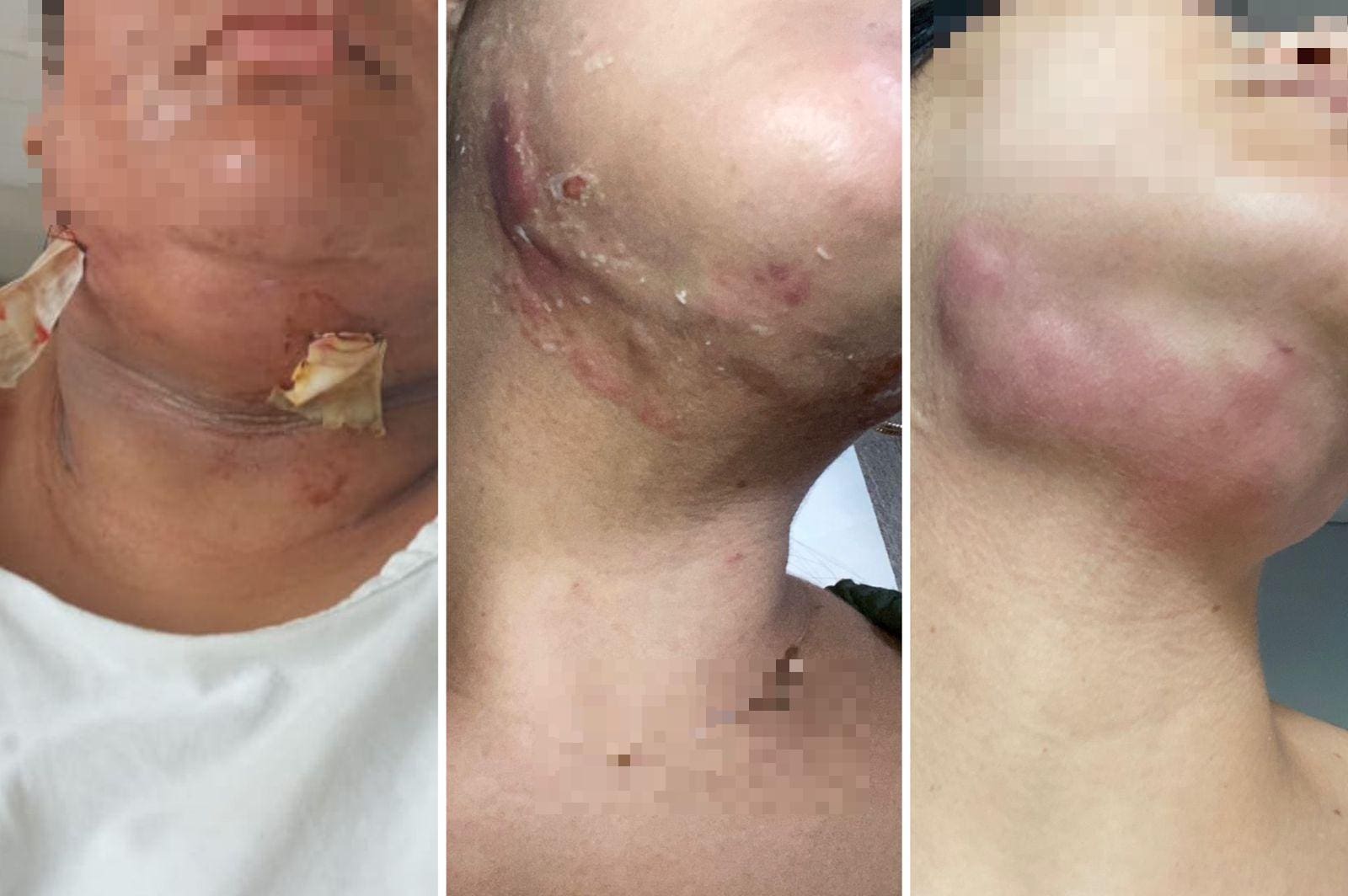 Mulheres sofrem com complicações após cirurgia de lipo de papada em clínica de BH