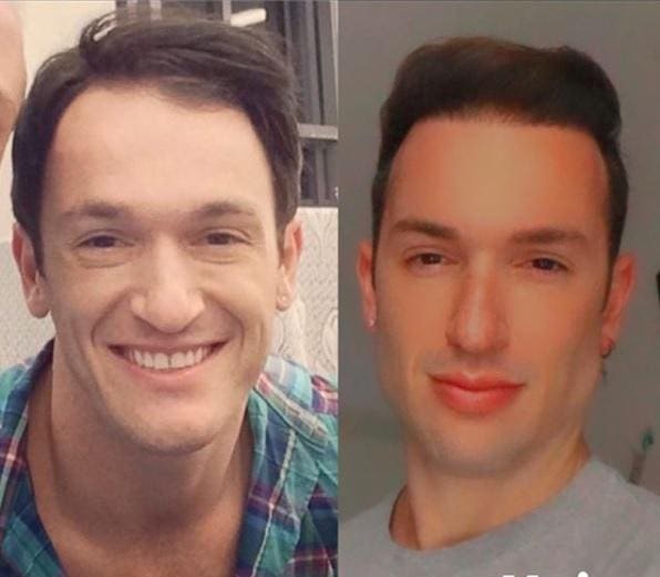 Ginasta Diego Hipólito já fez harmonização facial